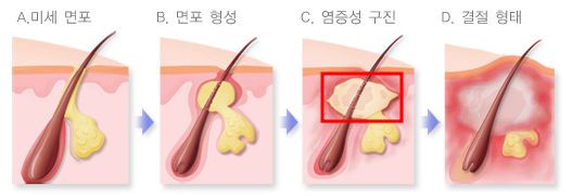 여드름 생성 과정. 출처 : 질병관리청