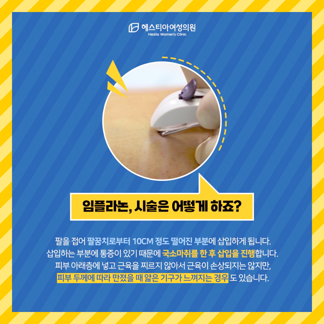 임플라논 시술은 어떻게 하죠?