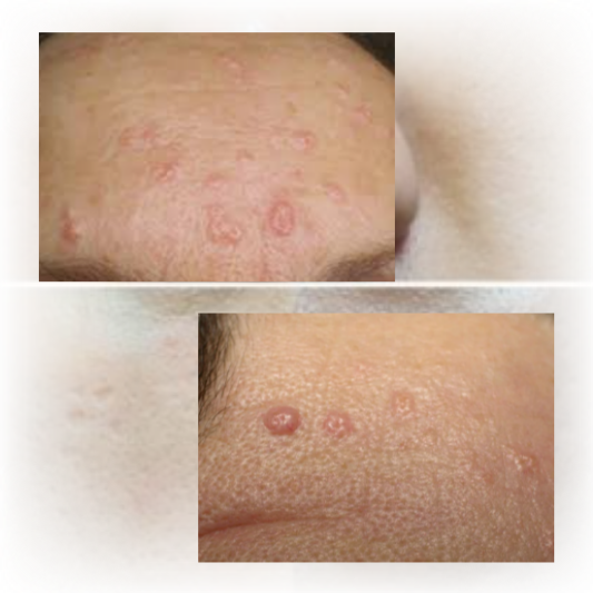 피지선증식증: 40대 이후 급증! 조기발견과 치료가 중요한 이유