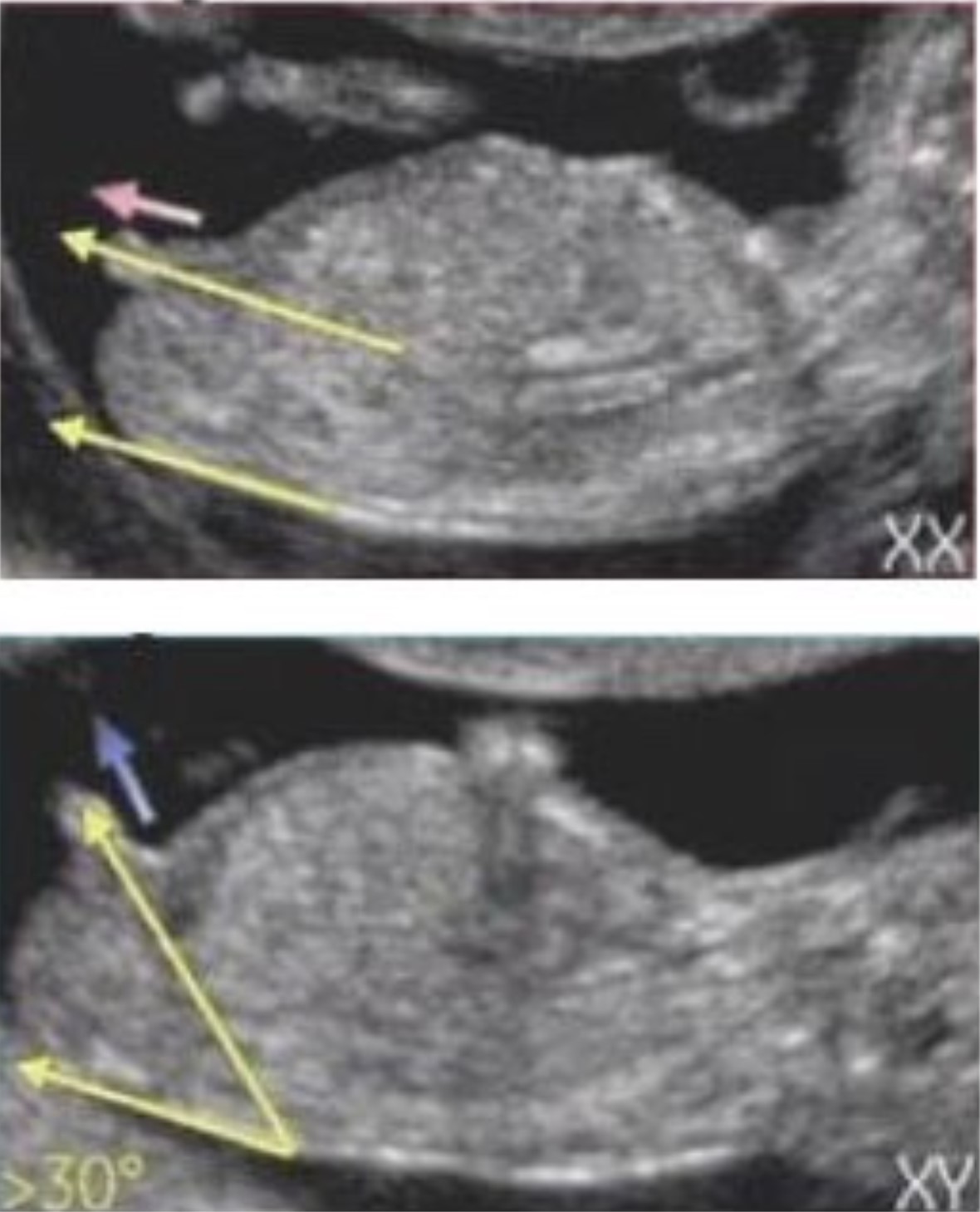 12주 각도법 성별2