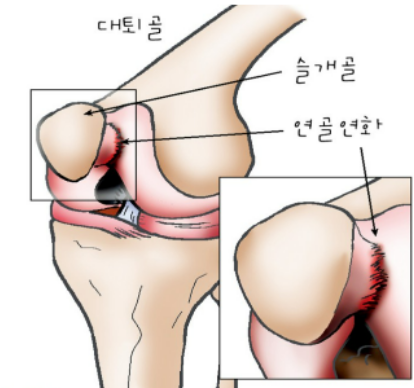 슬개골 무릎사진