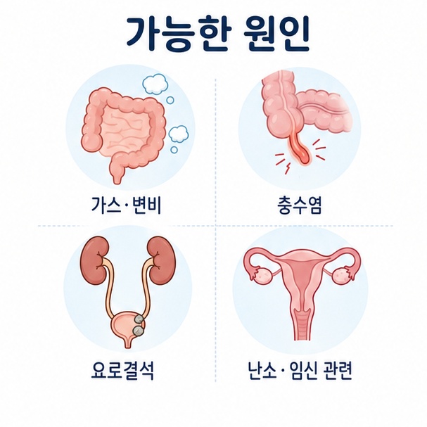 오른쪽 아랫배 통증의 원인으로 가스·변비, 충수염, 요로결석, 난소 및 임신 관련 문제를 구분해 표현한 그림