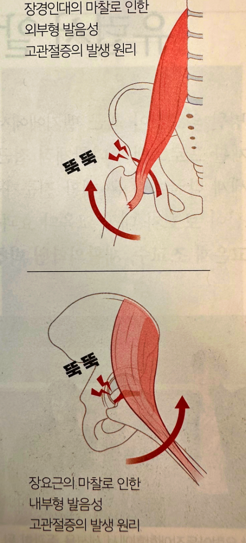 외부형, 내부형 발음성 고관절증의 발생 원인을 나타내는 이미지