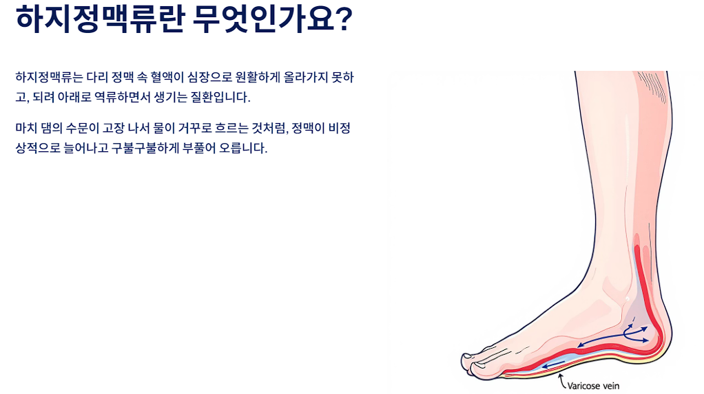 하지정맥류란 무엇인가요?