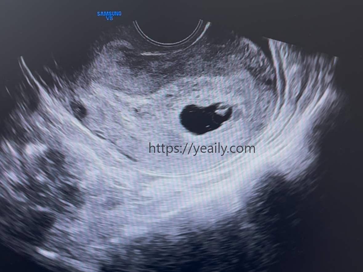 계류유산 판정받은 초음파