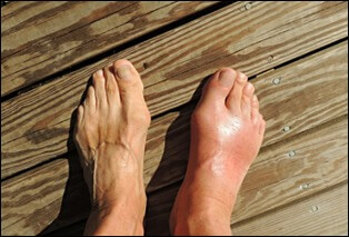 요산수치 낮추는 음식 4