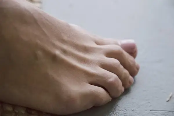 내 발에 사마귀? 티눈? 혼동될 때 알아야 할 차이점과 치료