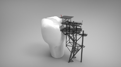 임플란트 시술의 장단점