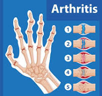 손가락 관절염 초기증상