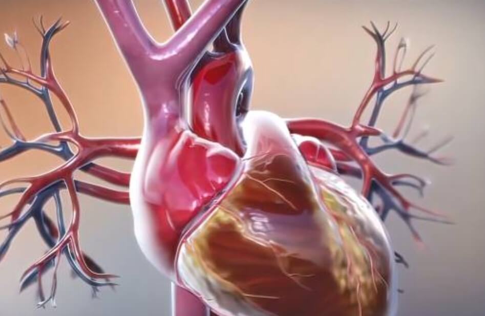 심장마비 전조증상