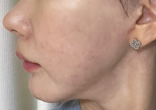 역삼역 여드름 피부과 여드름 없애는 시술 후기