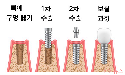 임플란트 치료과정