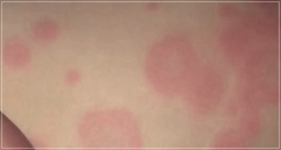 사타구니 백선 치료법 3가지 추천.