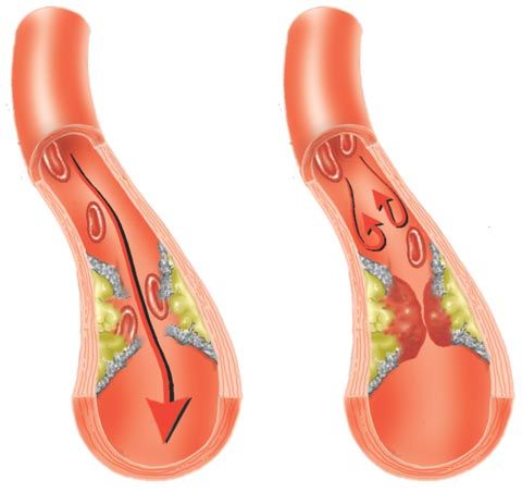 ldl 콜레스테롤 낮추는 방법
