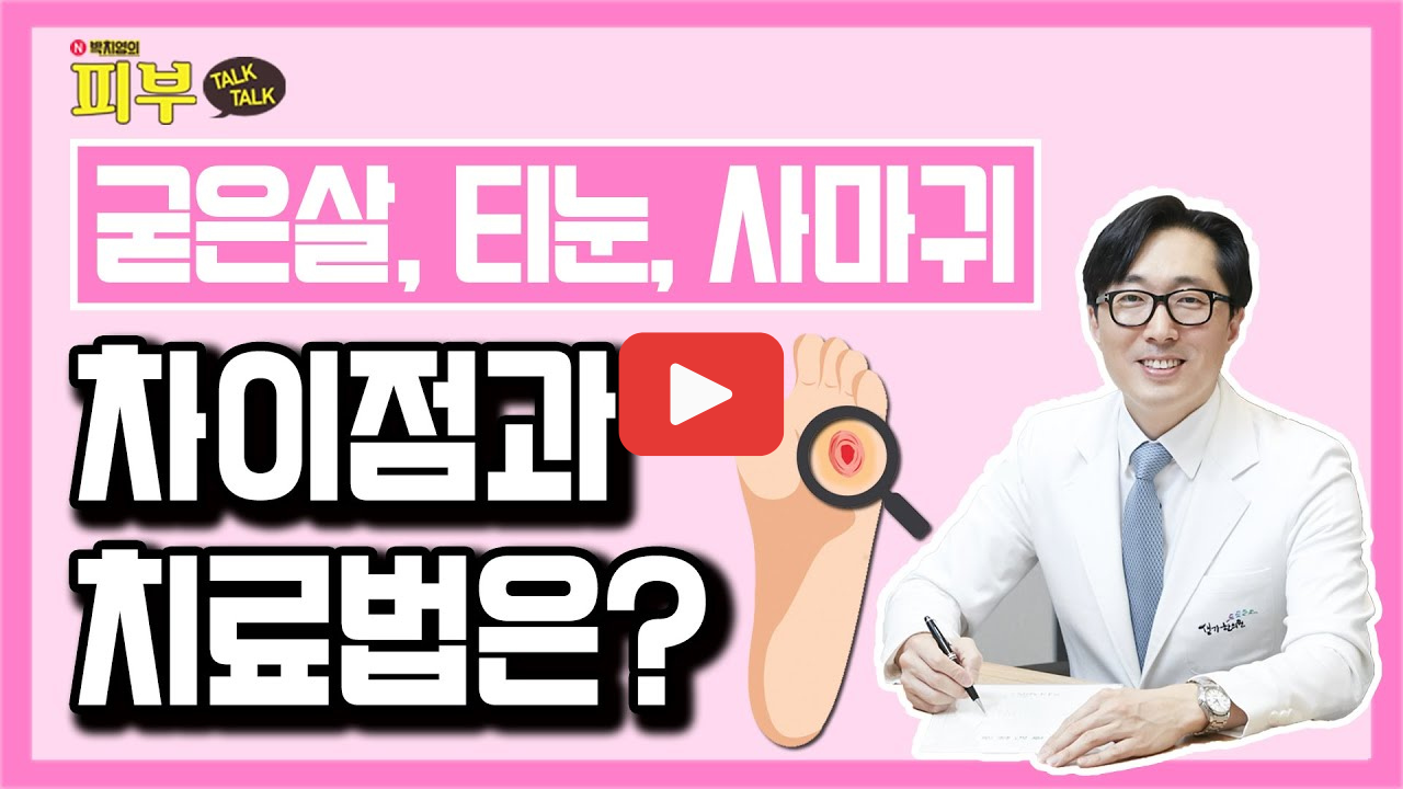 티눈 굳은살 차이 알아보기