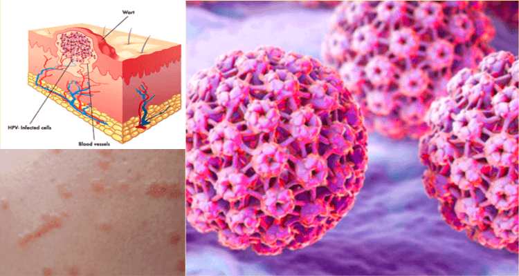 사마귀바이러스