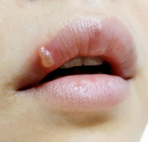입술 포진(구순포진)