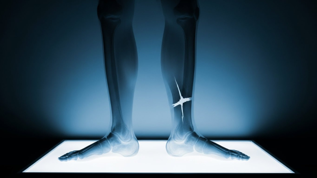 비골 골절이 보이는 하퇴부 X-ray 필름 모식도