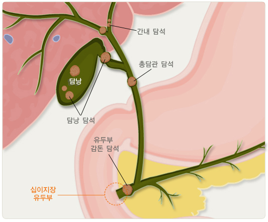 담석증