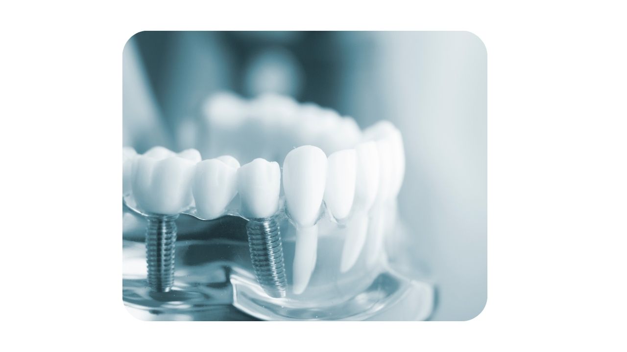 창원 임플란트 전문치과