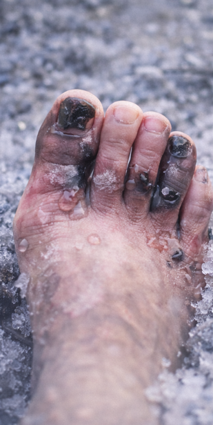 동상, 단순 추위가 아니라 조직 손상까지 가는 단계 관련 사진