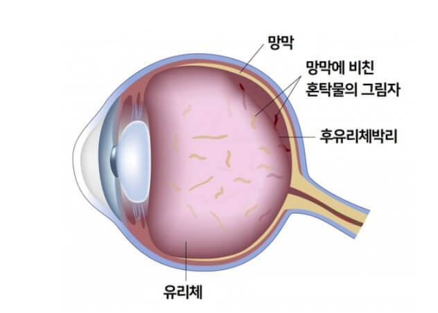 망막박리 및 망막열공을 그림으로 설명
