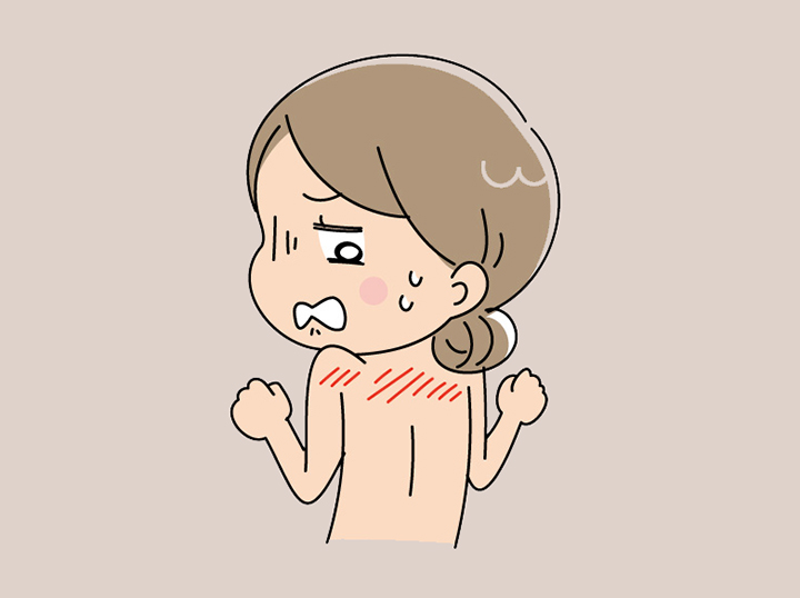 홍반-증상이-나타난-여성