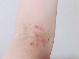 피부발진의 종류 