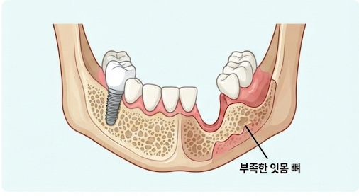 뼈이식 임플란트