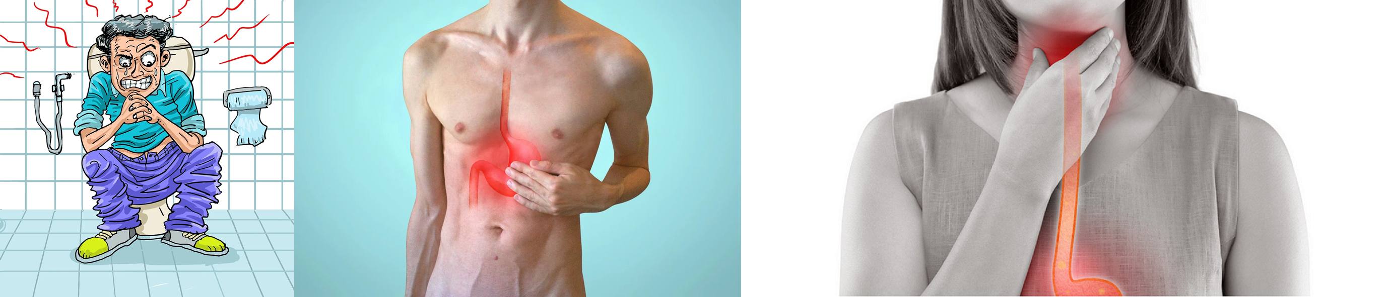 기능성-소화장애,-위배출-장애,-위식도-역류장애