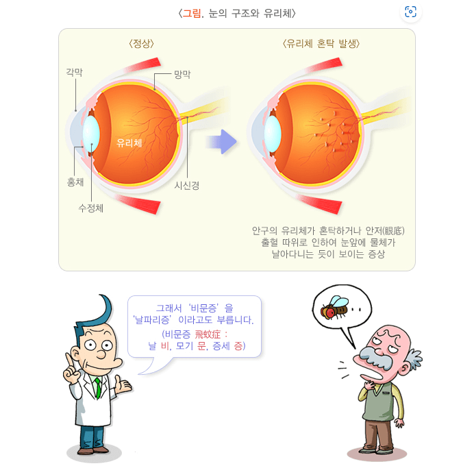 비문증