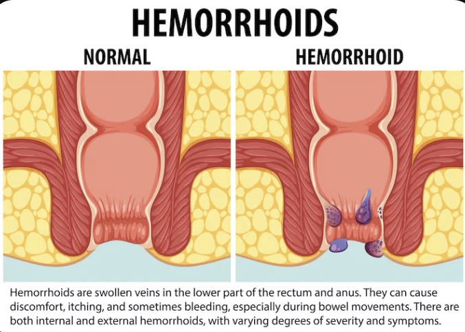 치질의 증상과 치질 자가치료법, 치질 예방법 요약정리