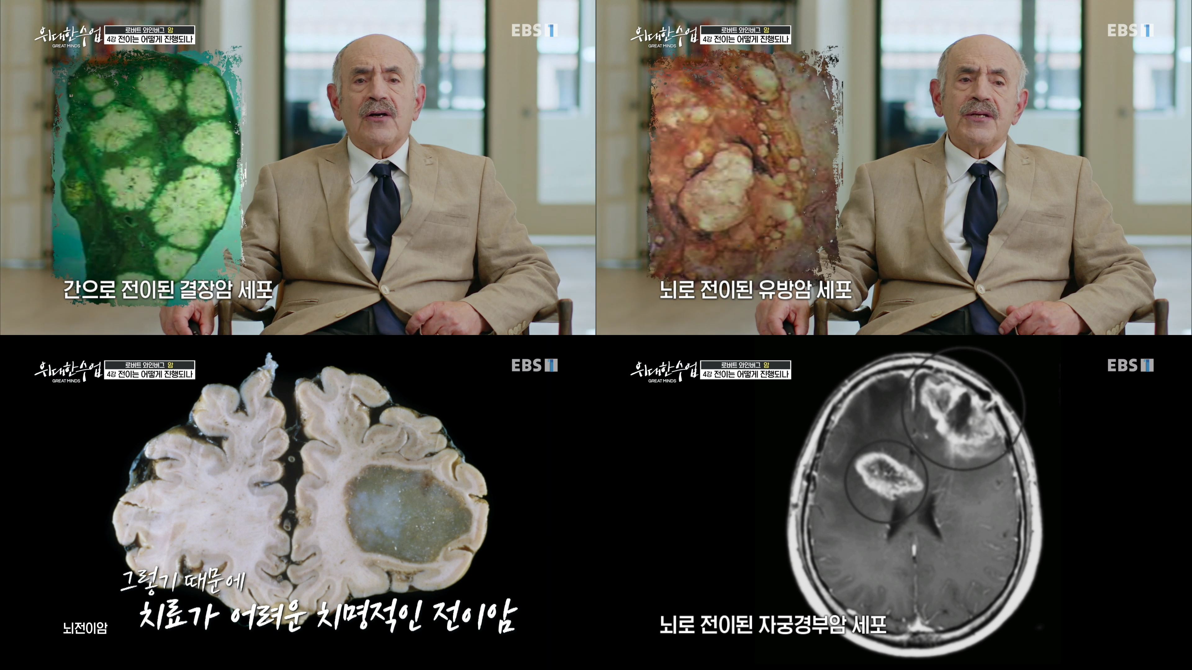전이암 사진