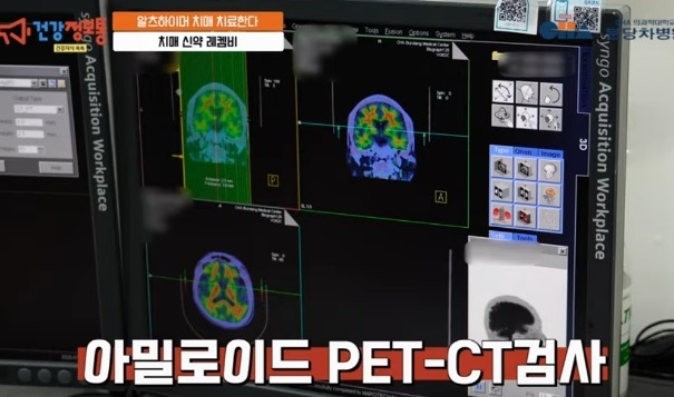 알츠하이머-치매-치료제-레켐비-레카네맙