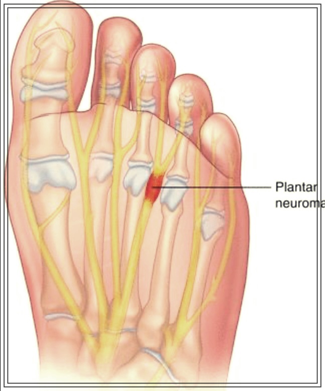 발바닥 고통, 그 원인은? 지간신경종의 정체와 치료법.