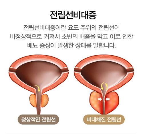 전립선비대증 치료방법 과연 있을까?