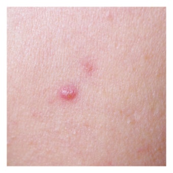 화농성 한선염 치료 수술 병원