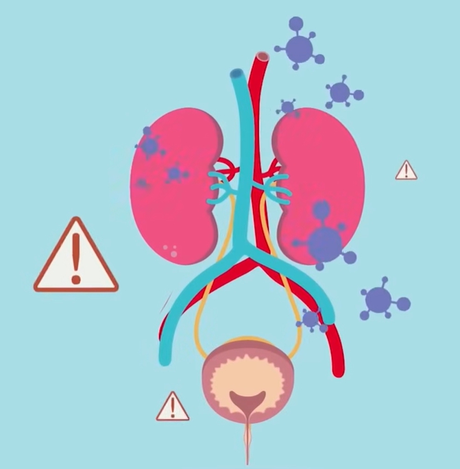 급성 신우신염 증상