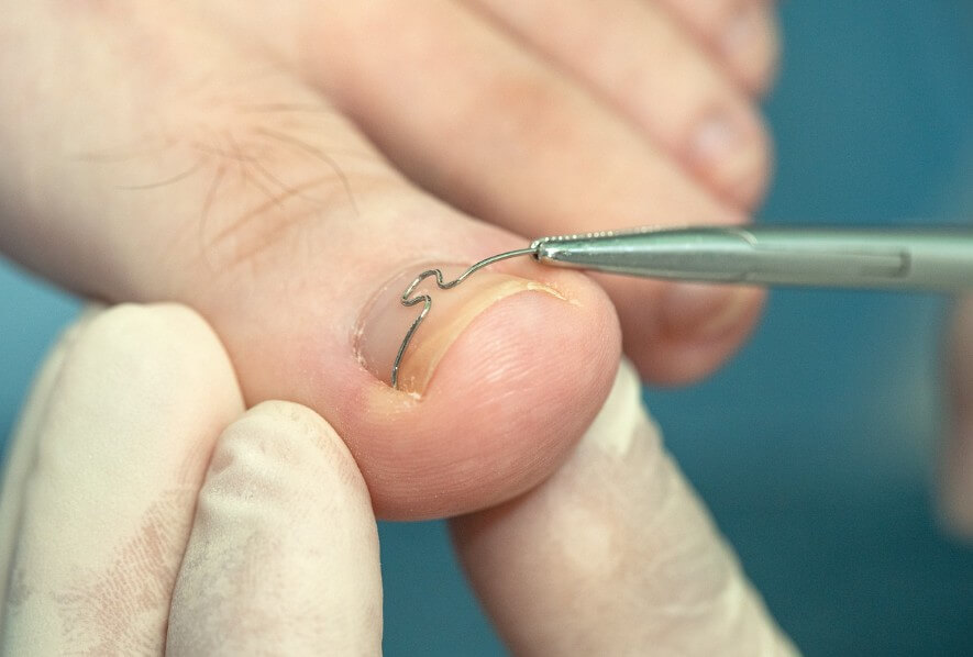 발톱 무좀 제거 시술