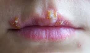 입술 포진 빨리 낫는법