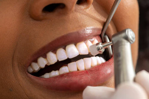 스케일링 의료보험 비용 혜택 5