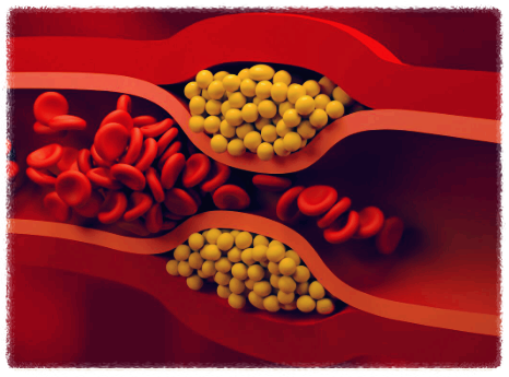 LDL콜레스테롤-낮추는방법