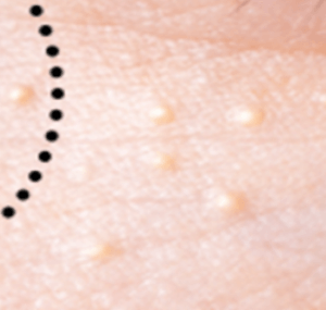 눈밑에 하얀 좁쌀