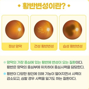 황반변성
