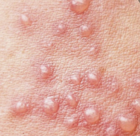 대상포진 이미지