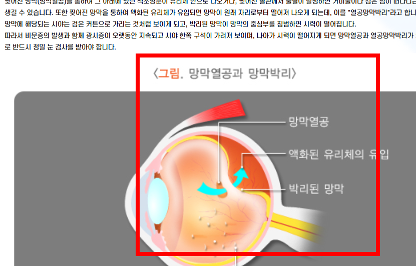 비문증 치료방법 알아보기