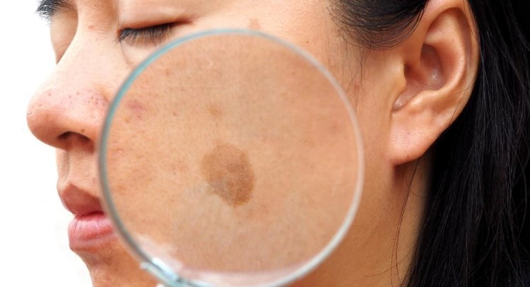 검버섯 없애는 방법