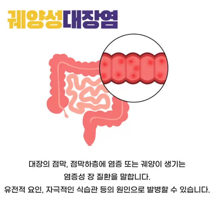 궤양성 대장염