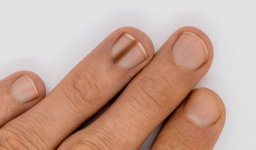 손톱 검은세로줄 원인 5가지