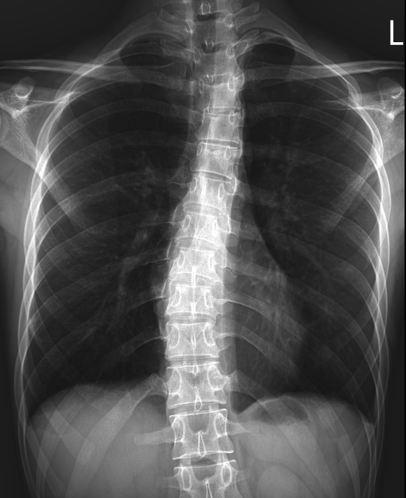 scoliosis
